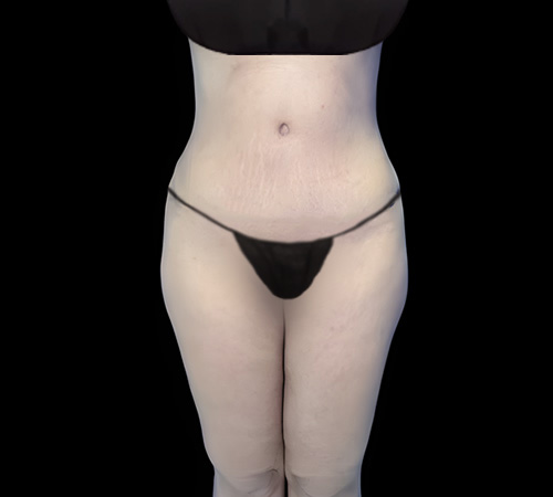 Lipo abdominoplastia Después