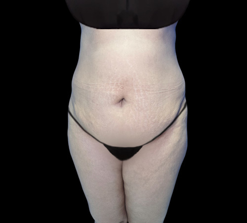 Lipo abdominoplastia Antes