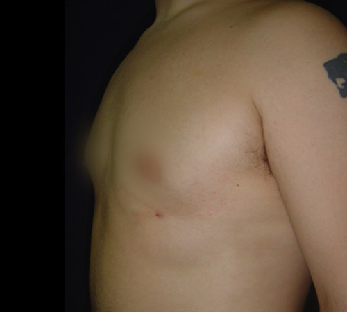 Ginecomastia Después