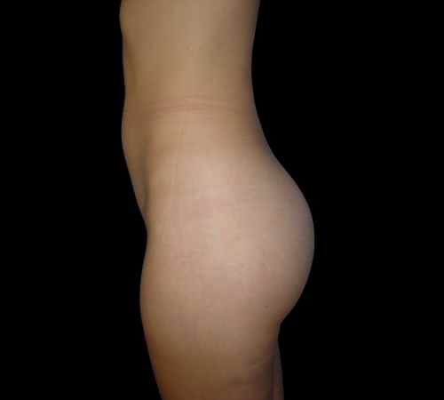 Gluteoplastia Después